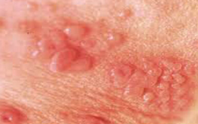 感染了生殖器疱疹患者常见有什么症状