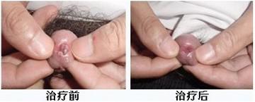 初步感染尖锐湿疣一般有什么症状